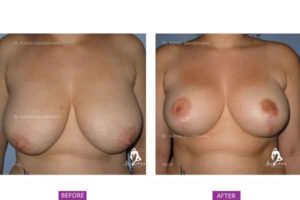 Breast Reduction Case 1: Superomedial Pedicle Breast Reduction Surgery