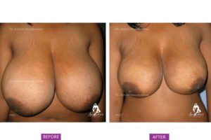 Case 2: Virginal Hypertrophy of Breast Treated by Liposuction Only