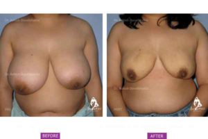 Case 3: Breast Reduction by Liposuction