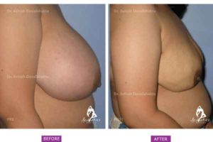 Case 3: Breast Reduction Surgery (Side View)