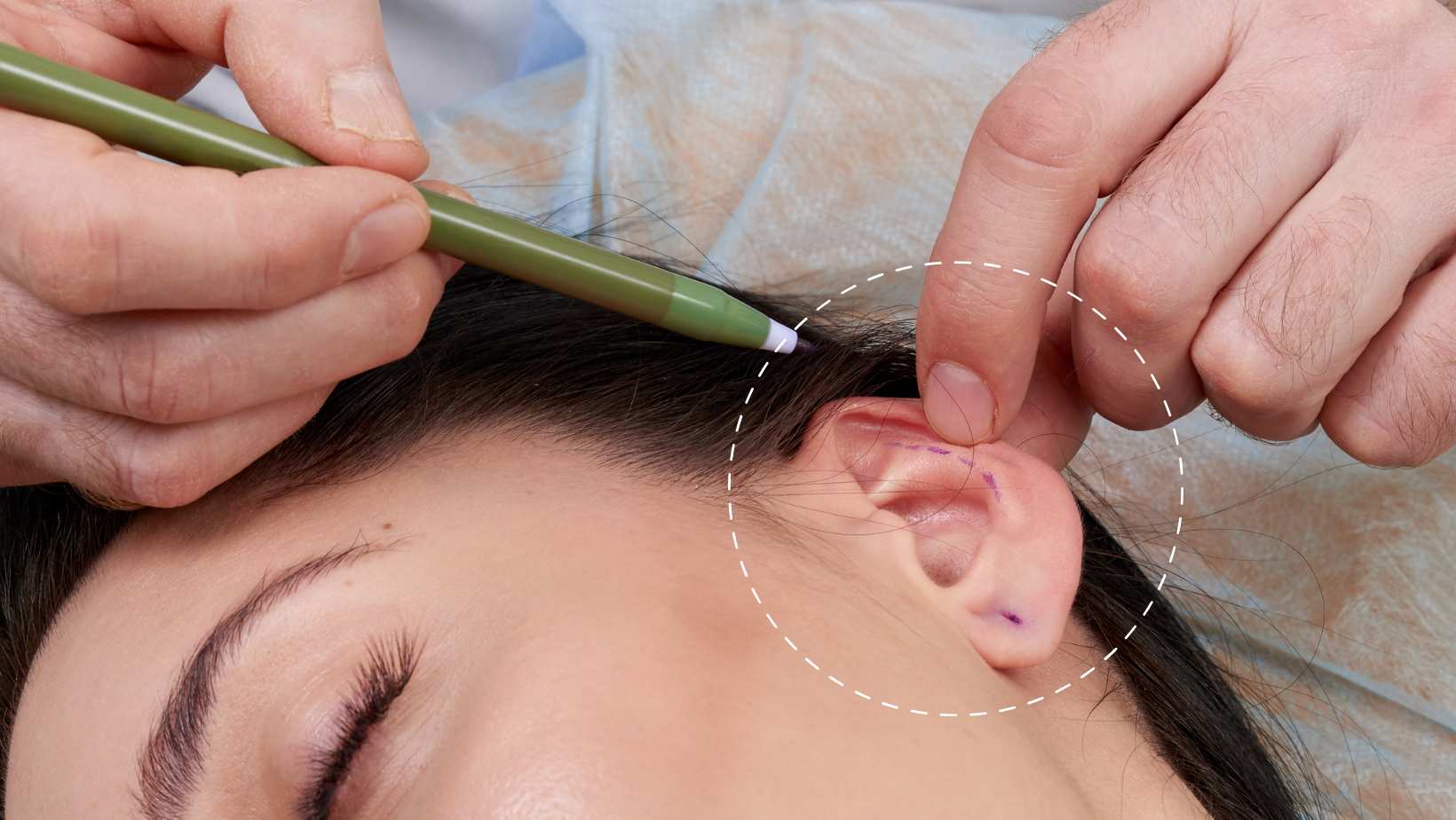 You are currently viewing 4 Key Reasons to Consider Ear Correction Surgery