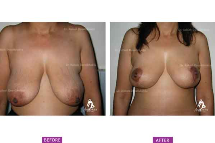 Breast Sagging Following Massive Weight Loss